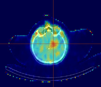 brain cancer
