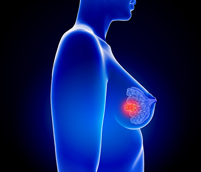 breast cancer breast cancer