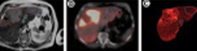 hepatocarcinoma hepatocarcinoma