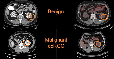 kidney cancer