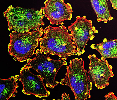 melanoma melanoma
