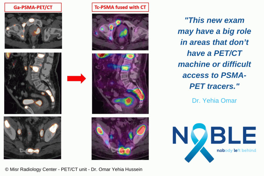 NOBLE Registry - Promising results with Tc-99m-iPSMA